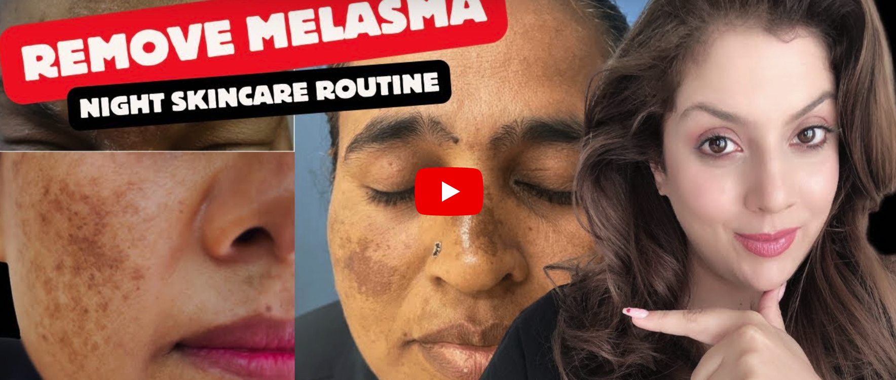 How to treat Melasma